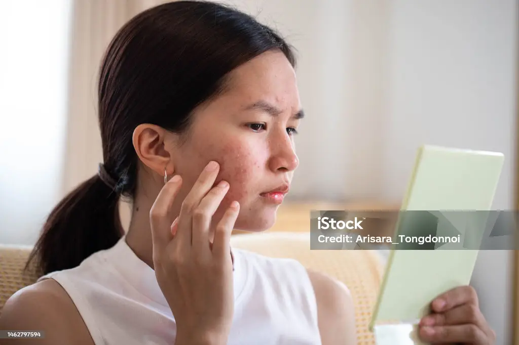 Yuk, Simak Bahan – Bahan Skincare yang Efektif Untuk Mengobati Jerawat